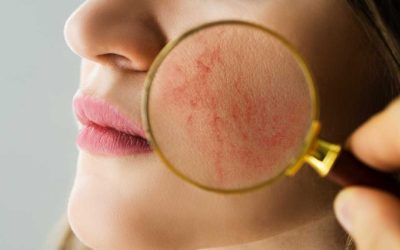 Rosacea A Short Overview