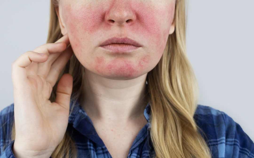 The Four Phases Of Rosacea