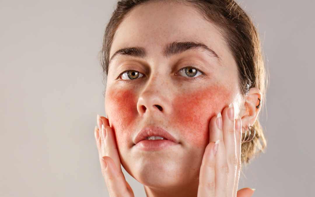 Dealing With Your Rosacea