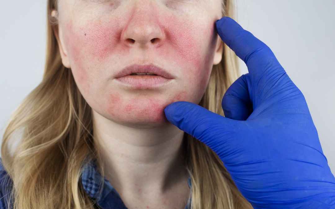 The Truth About Rosacea