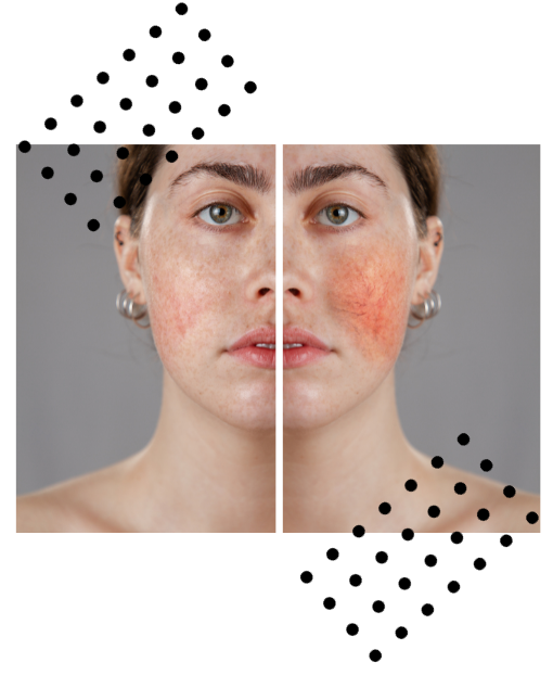 rosacea-top